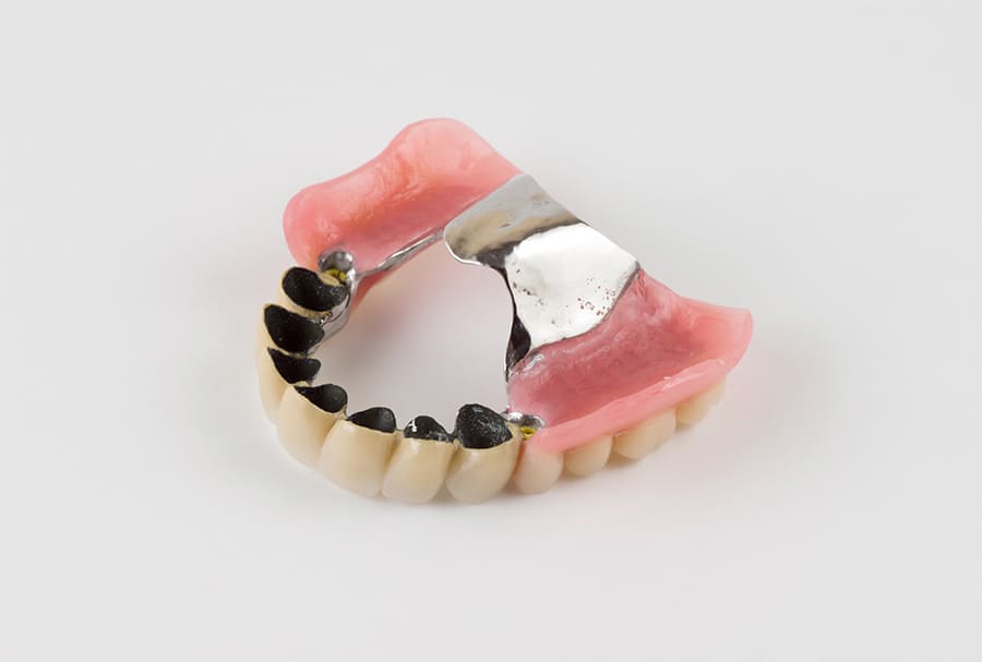 テレスコープ義歯
                