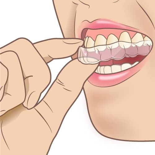 マウスピースを装着する様子