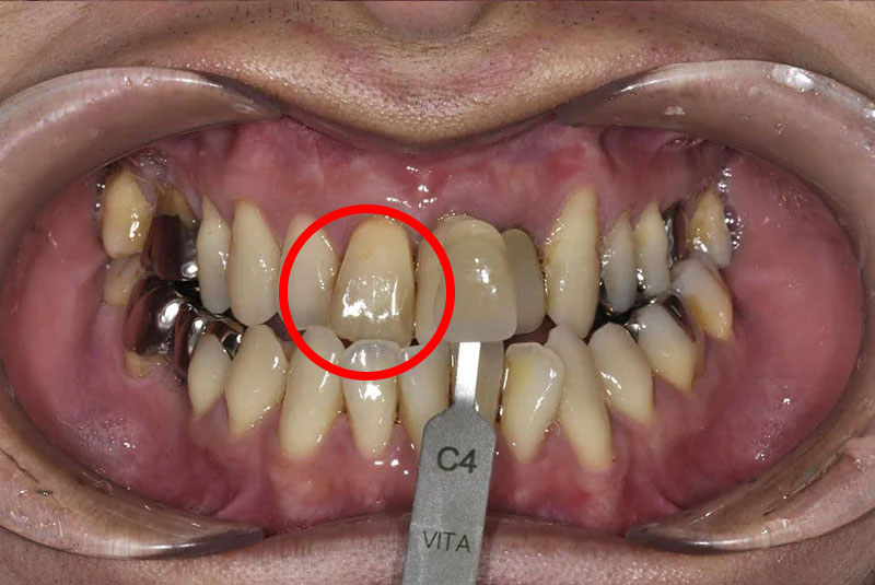 ウォーキングブリーチ症例 ウォーキングブリーチ(1回目の薬剤交換時)Shade guideとの比較写真
