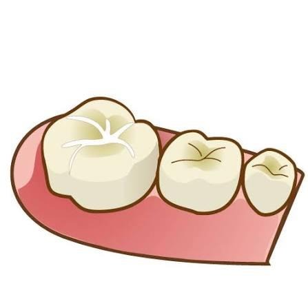虫歯を治療した歯