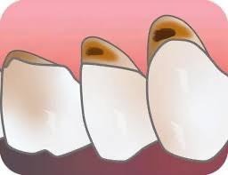 歯と歯茎の境目