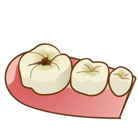 虫歯になった歯
