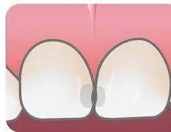 虫歯になりやすい前歯