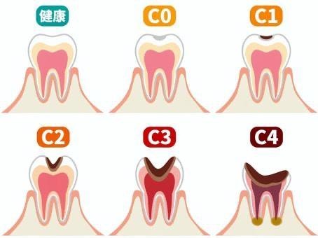 虫歯の進行