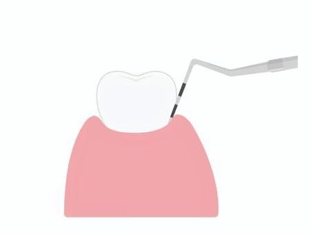 歯周ポケットの検査