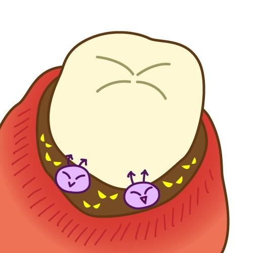 炎症を起こした歯茎