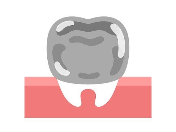 被せ物のイメージ