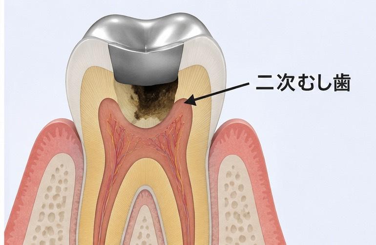 二次銀歯の下の虫歯