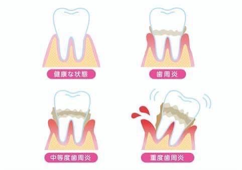 歯周病が進行する様子